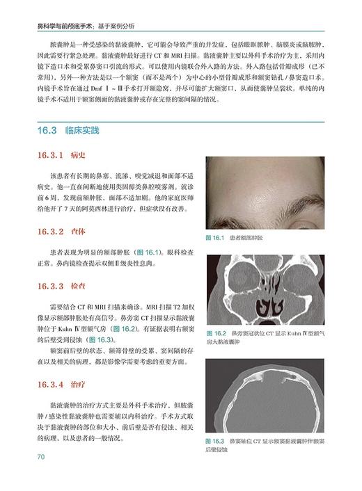 鼻科学与前颅底手术 基于案例分析 瞿申红主译 鼻科前颅底面部整形等临床病例诊断治疗 耳鼻喉外科 辽宁科学技术出版社9787559133137 商品图3