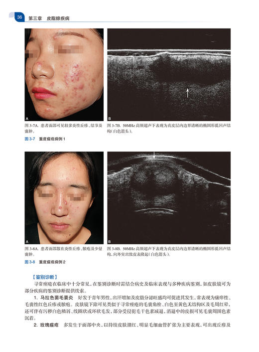 损容性皮肤病影像诊断 刘洁 朱庆莉 皮肤影像学在各种损容性皮肤病病情评估治疗监测等方面的应用 人民卫生出版社9787117352246 商品图4