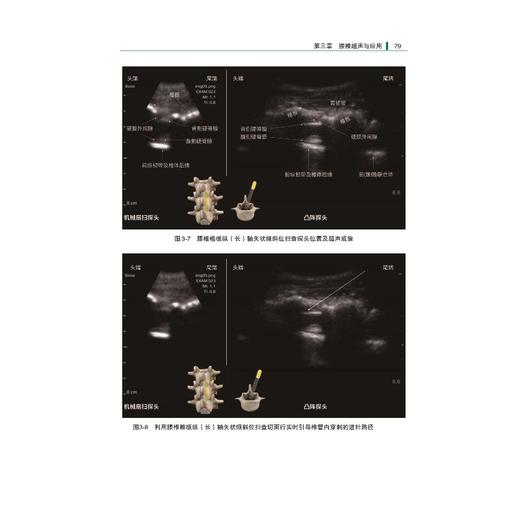 麻醉与疼痛治疗相关脊柱超声切面解析 商品图1
