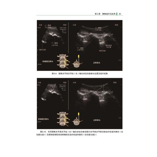 麻醉与疼痛治疗相关脊柱超声切面解析 商品图2