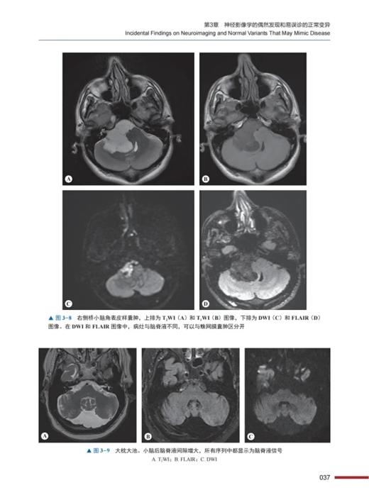 ESNR临床神经放射学 上下全2卷 张龙江 刘亚欧主译 神经系统各类疾病影像学表现临床经典病例 中国科学技术出版社9787523600979 商品图4