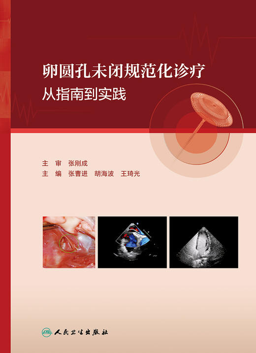 卵圆孔未闭规范化诊疗——从指南到实践 2024年2月参考 商品图1
