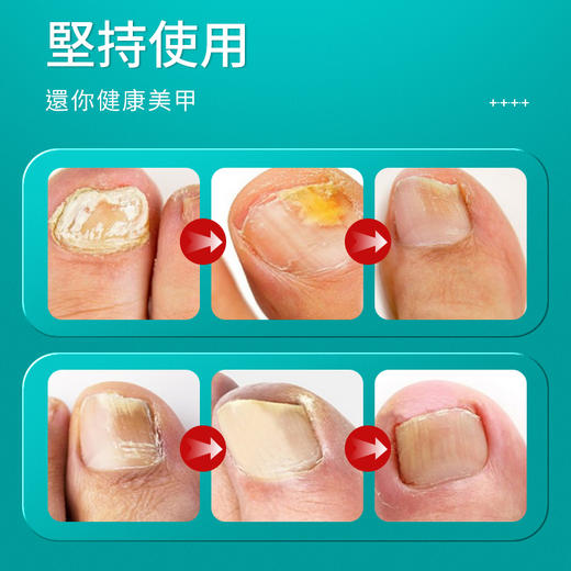 【买一送一】香港大药房洃甲抑菌液 四大中草药配方 温和调理呵护指甲 安全无痛使用简单 30ML/瓶 商品图4