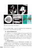 卵圆孔未闭规范化诊疗 从指南到实践 张曹进 胡海波 王琦光 PFO影像学诊断操作步骤 规范化治疗 临床实际案例应用 人民卫生出版社 商品缩略图4