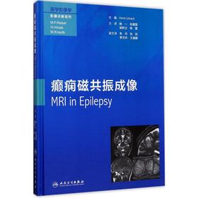 癫痫磁共振成像