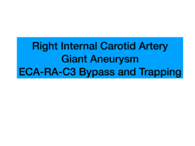 Top4.右颈内动脉巨大动脉瘤ECA-RA-C3 Bypass&Trapping