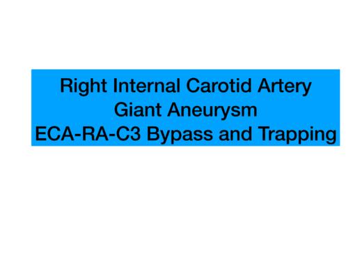 Top4.右颈内动脉巨大动脉瘤ECA-RA-C3 Bypass&Trapping 商品图0