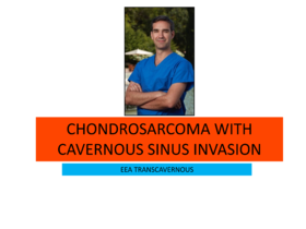 2023Top3. Chondrosarcoma