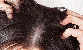  艾草去头屑小窍门，绿色方法不伤发质 