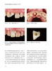 垂直型牙体预备和生物导向预备技术BOPT 刘峰等编 口腔临床牙体预备技术详细操作步骤 病例精选 辽宁科学技术出版社9787559132123 商品缩略图3