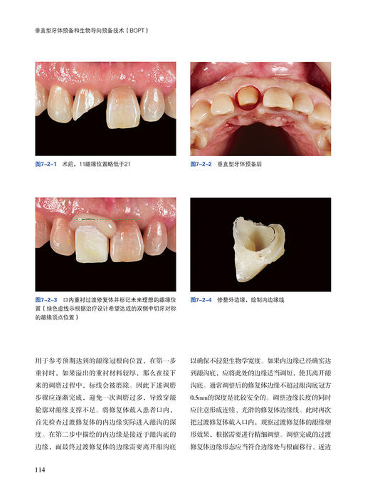 垂直型牙体预备和生物导向预备技术BOPT 刘峰等编 口腔临床牙体预备技术详细操作步骤 病例精选 辽宁科学技术出版社9787559132123 商品图3