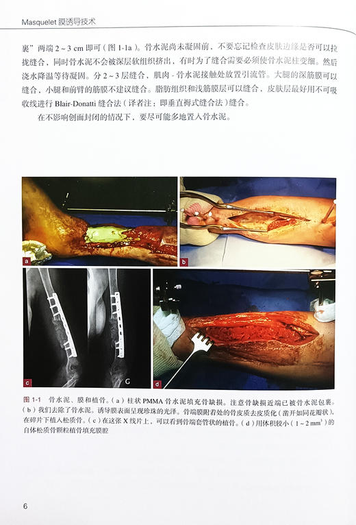 Masquelet膜诱导技术 阐述了该技术的由来与实施方法以及卓有成效的治疗实践 骨损伤研究 北京大学医学出版社9787565931048  商品图4