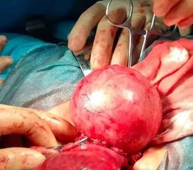  ​女人灸灸这3穴，有效防治肌瘤和囊肿 