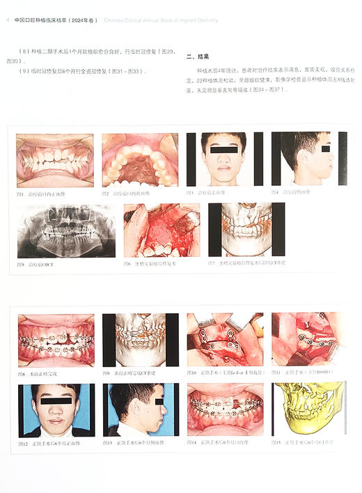 中国口腔种植临床菁萃 2024年卷 王兴 刘宝林 主编 口腔临床技术病例 种植牙 口腔外科学 辽宁科学技术出版社9787559134103 商品图4