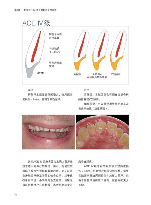 三步法牙齿磨耗微创修复 弗朗西丝卡 瓦莱塔 主编 咬合重建治疗功能美学重建口腔临床 口腔修复 辽宁科学技术出版社9787559132000  商品图3