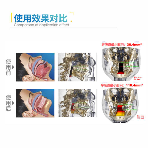 1【大额优惠咨询客服】思华医疗止鼾--定制式止鼾器 中国智造 解决低通气和鼾症 商品图1