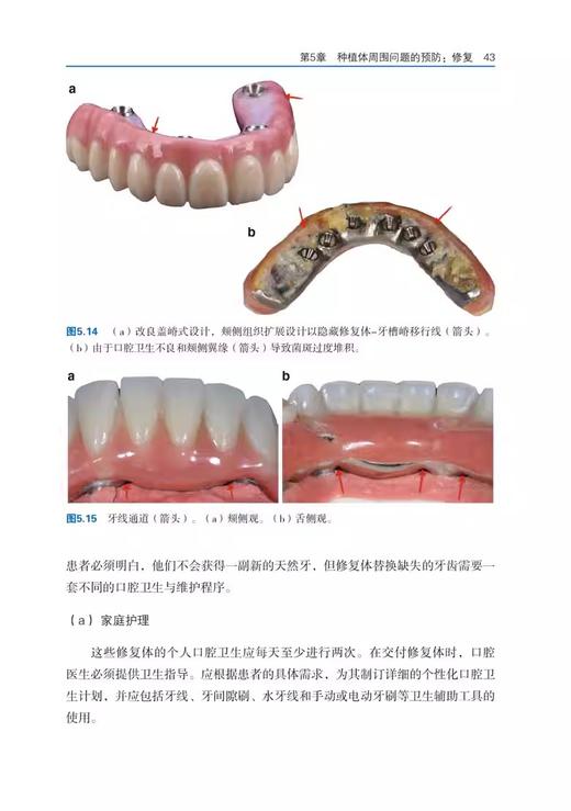 直面种植治疗失败 预防 维护和治疗的临床指南 黄建生 治疗方案的制订 种植体的植入技术 辽宁科学技术出版社9787559132949  商品图4