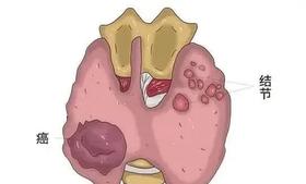  结节到底怎么消除 ？看完你就知道了 
