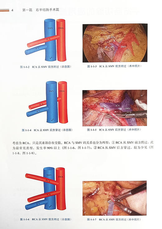 腹腔镜结直肠肿瘤手术难点与创新 直肠乙状结直肠右半肠左半肠手术切除 超全直肠系膜切除手术技巧 北京大学医学出版9787565929878 商品图4