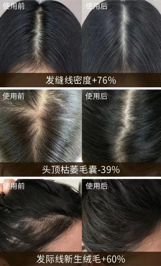 【清仓好价】日本漾新族防脱育发精华露200ml（效期至25.2） 商品图2