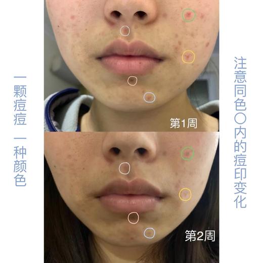 【清仓好价】Hiruscar喜辽复痘印舒缓凝胶5g*2支（效期至24.10） 商品图3