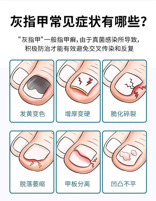 【泰国TH百想皮灰甲膏】不包扎、不伤肤、不拔甲，真正治疗灰指甲的性价比之王！天然草本配方，深层渗透 直击根部!不给真菌 喘气空间 轻松拥有透亮健康甲 商品图4