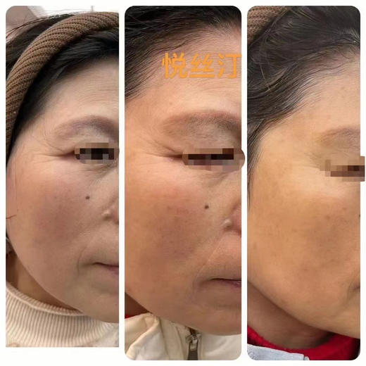 悦丝汀重组人源胶原蛋白水光5ml抗老收缩毛孔提亮肤色 商品图8