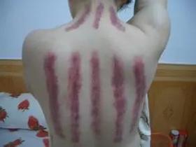  刮痧痛不痛，关键是看你“通不通” 