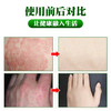 【湿疹止痒】云南本草百草止痒膏 湿疹成人止痒外用皮肤瘙痒膏 四季常备 防止皮肤瘙痒 商品缩略图2