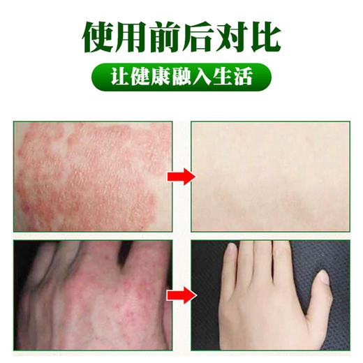 【湿疹止痒】云南本草百草止痒膏 湿疹成人止痒外用皮肤瘙痒膏 四季常备 防止皮肤瘙痒 商品图2