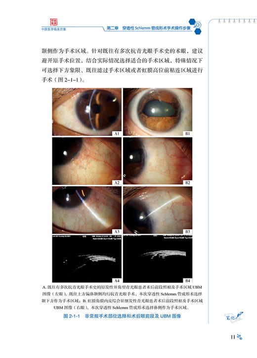 穿透性Schlemm管成形术与典型病例 梁远波主编 青光眼眼外科手术操作 临床应用典型病例研究分析 科学技术文献出版社9787523513569 商品图4