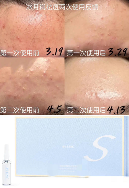 冰月岚净痘3ml加三文鱼婴儿针 淡化痘印痘 商品图5
