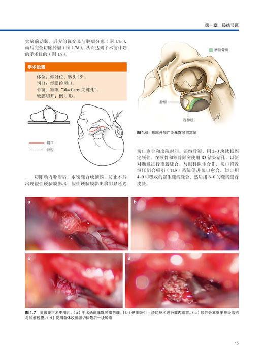 颅底手术策略 附视频 黄国栋主译 颅底肿瘤生物学特征 汇集著名神经外科专家治疗理念执行策略 辽宁科学技术出版社9787559131812 商品图4