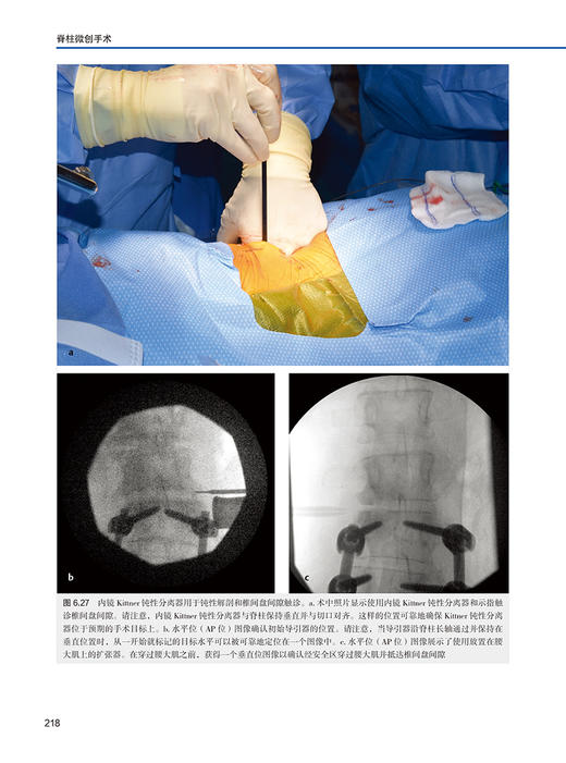 脊柱微创手术 附视频 文天林 祝斌 丁凡主译 脊柱微创手术技术和细微差别 脊柱矫形外科入门读物 辽宁科学技术出版社9787559132086 商品图4