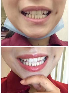 用它刷牙，牙黄牙垢黑斑唰唰落，修补牙釉质，烂牙变好牙！