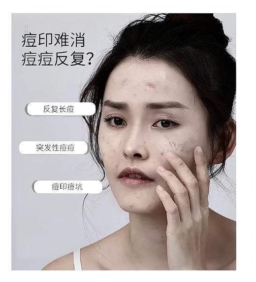 【中欧班列精选】印度西玛啦雅Himalaya痘痘修复霜30g/支 cs 商品图1