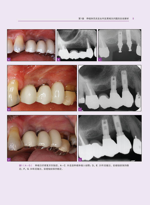 种植体周炎的全面解析 预防 诊断和治疗 王鸿烈 徐淑兰 种植体周炎诊断口腔科学种植口腔专业书籍 辽宁科学技术出版9787559134271  商品图4