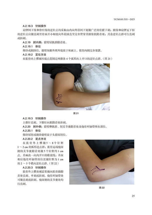 银质针技术操作规范 中国民族医药学会 编著 中医针刺疗法技术临床操作规范及应用 疼痛科关键技术 中医古籍出版社9787515228396 商品图4