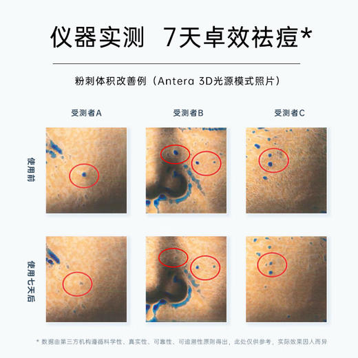 碧绽美水杨酸祛痘凝胶50g华西专利清痘净痘控油保湿肌肤 商品图2