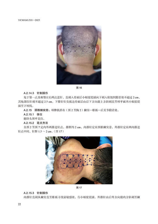 银质针技术操作规范 中国民族医药学会 编著 中医针刺疗法技术临床操作规范及应用 疼痛科关键技术 中医古籍出版社9787515228396 商品图3