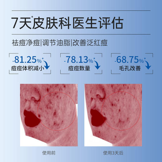 【买3送8片】复因FOY复合酸祛痘焕肤面膜单盒 25ml*5片/盒【院线同款】调节油脂 缓解泛红 ***2件9折、3件8折 商品图2