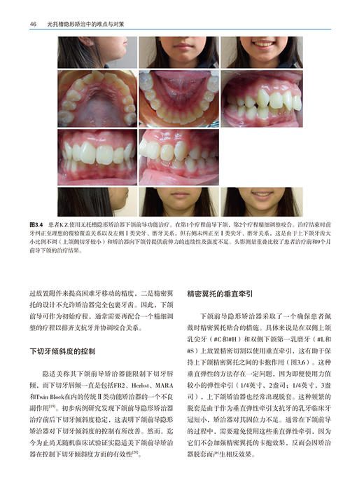 无托槽隐形矫治中的难点与对策 王璟 简繁 主译 口腔正畸牙托隐形矫治修复学口腔矫治难点对策 辽宁科学技术出版社9787559132796  商品图4