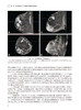 锥光束乳腺CT诊断 苏丹柯 金观桥 刘丽东 CBBCT新型乳腺诊查专用成像技术系统原理与临床诊疗应用 人民卫生出版社9787117362887 商品缩略图4