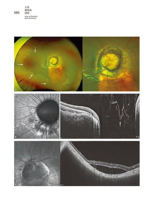 儿童眼底病图谱 丁小燕 中山大学眼科中心典型小儿眼底疾病分类介绍特征图片 实用小儿眼部检查手段 人民卫生出版社9787117362726 商品图4