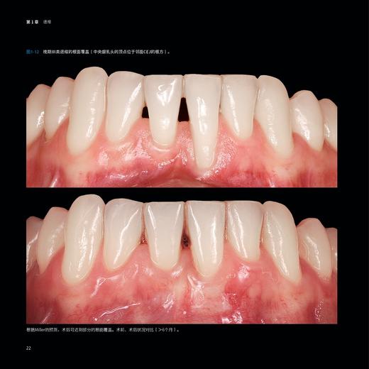 隧道瓣 牙周整形手术的全新治疗理念 宁杨 万鹏主译 隧道瓣技术 口腔科微创牙周整形显微外科手术9787559135339辽宁科学技术出版社 商品图3