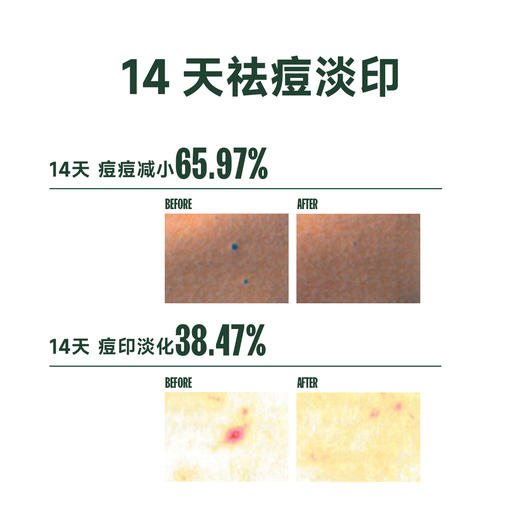 【官方授权】芙芙美背喷雾150ml/身体祛痘泡泡沐浴露330ml 疏通毛孔改善胸背豆豆平衡油脂代谢角质 商品图4