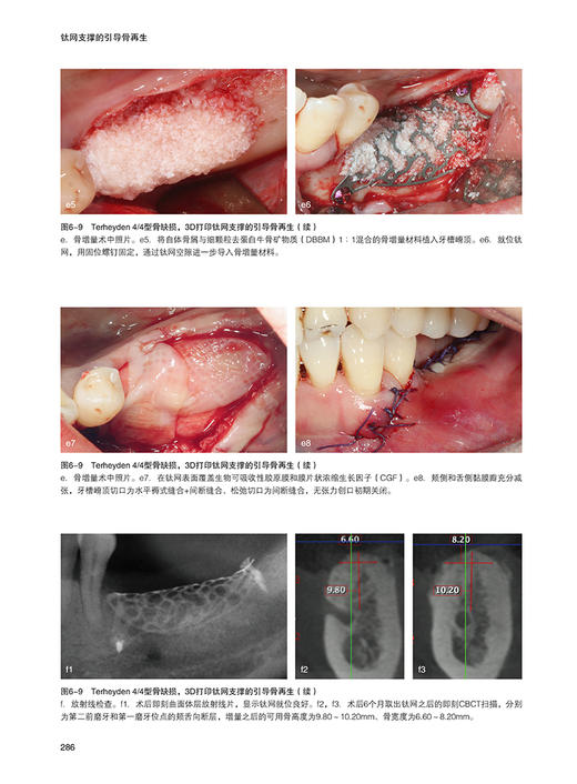 钛网支撑的引导骨再生 宿玉成 3D打印技术 TMs-GBR技术临床应用手术程序病例分析 口腔科学牙再植9787559133045辽宁科学技术出版社 商品图4