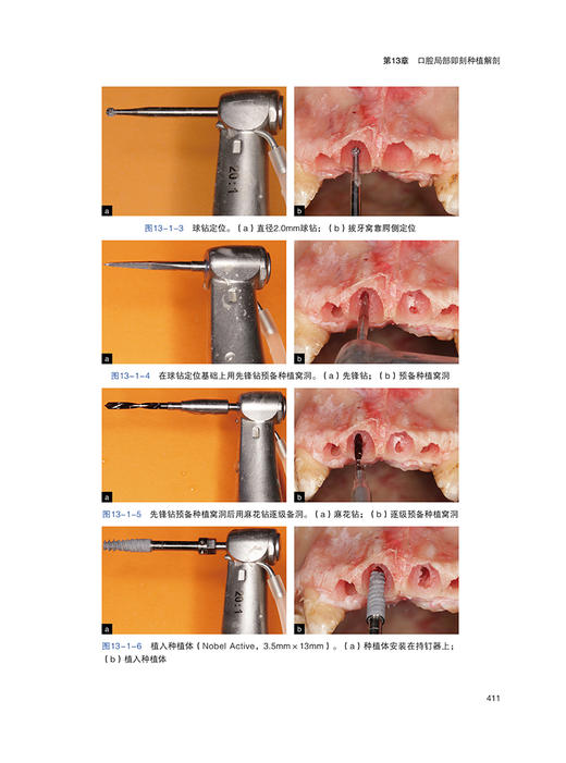 口腔种植临床解剖学 邹多宏 临床解剖要点种植操作技巧解释说明 局部解剖结构剖析 临床实际案例 辽宁科学技术出版社9787559131423 商品图3