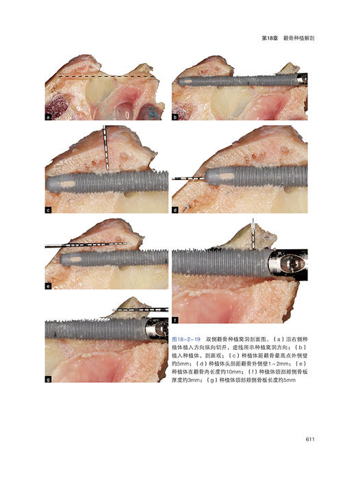 口腔种植临床解剖学 邹多宏 临床解剖要点种植操作技巧解释说明 局部解剖结构剖析 临床实际案例 辽宁科学技术出版社9787559131423 商品图4