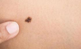 小痣也有大学问？孩子身上这5种痣最好别留！赶快自查→
